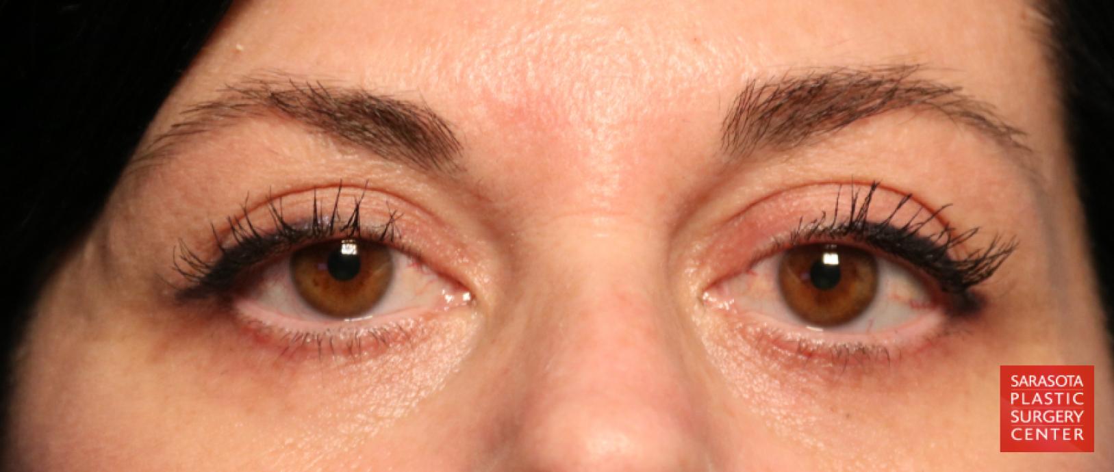 Eyelid Lift: Patient 14 - After 1