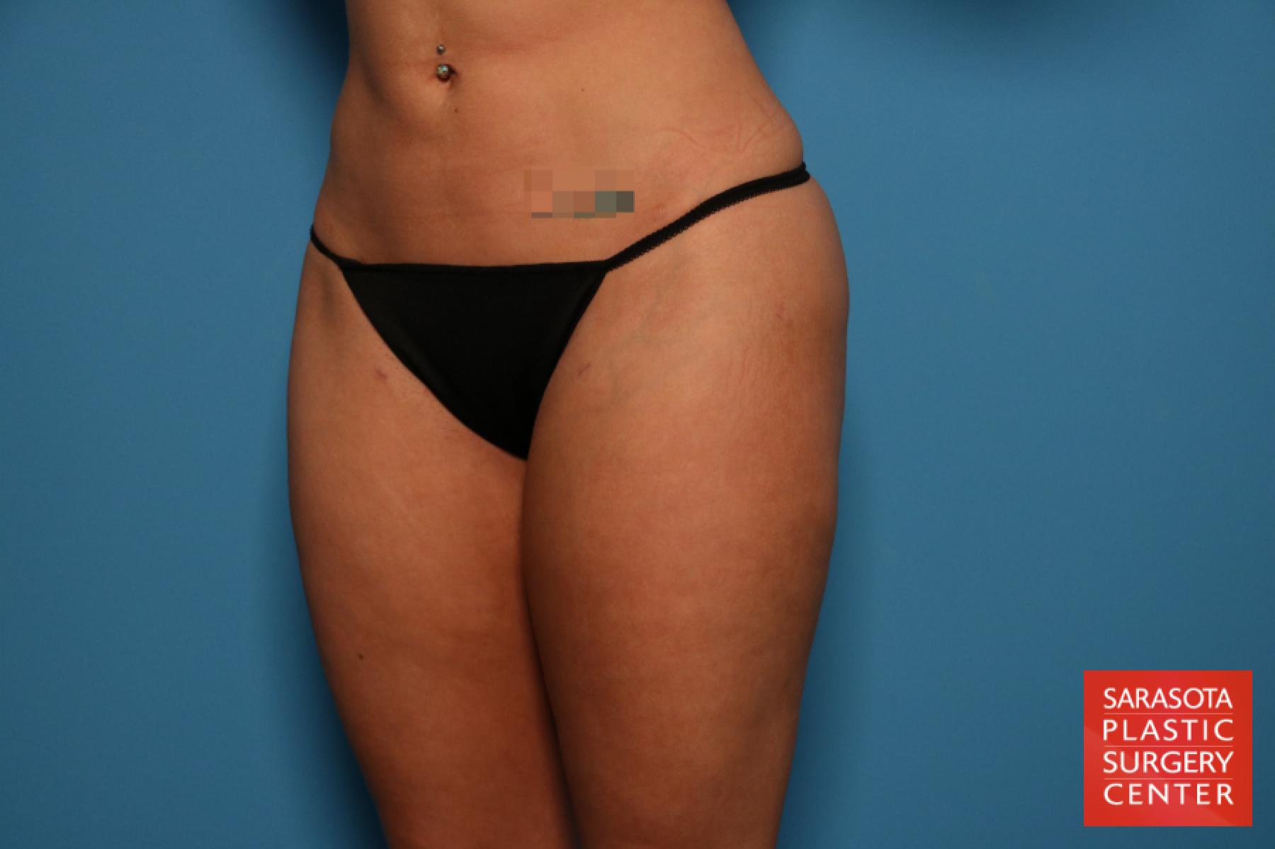 Liposuction: Patient 5 - After 2