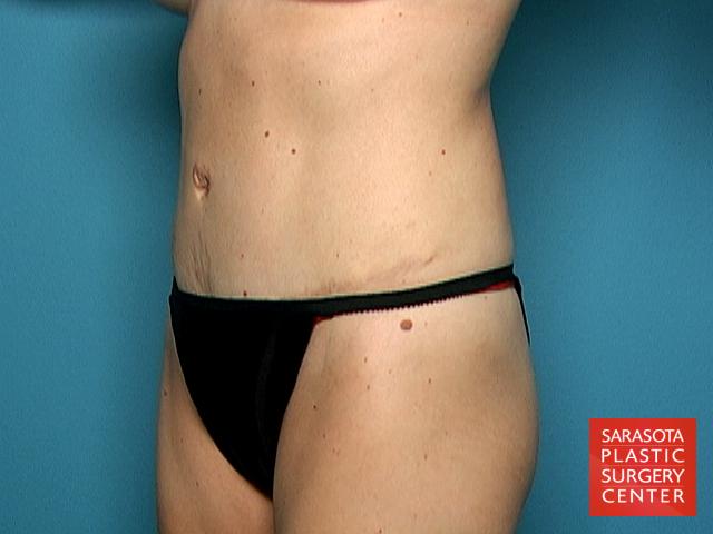 Tummy Tuck: Patient 6 - After 2
