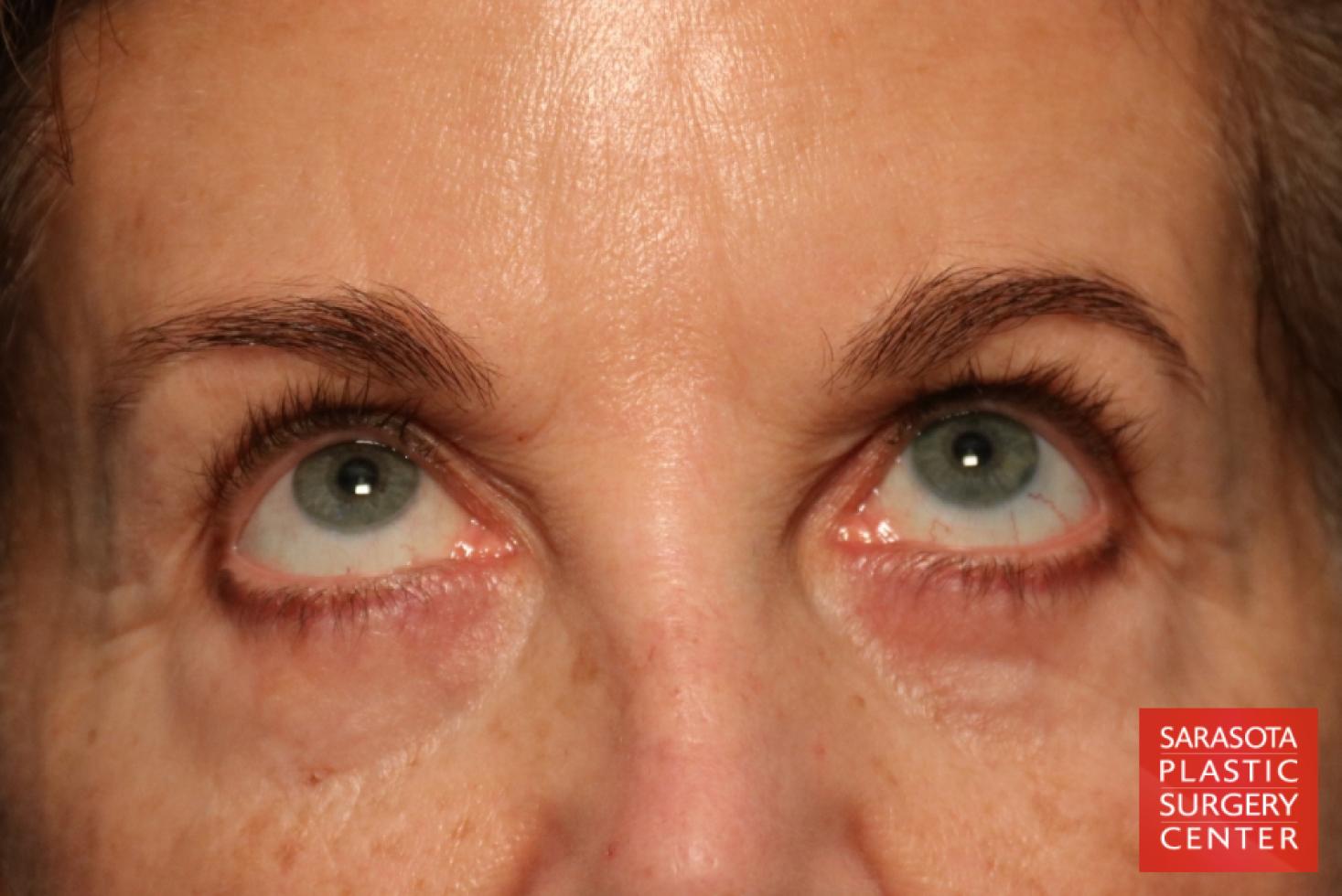 Eyelid Lift: Patient 39 - Before 2
