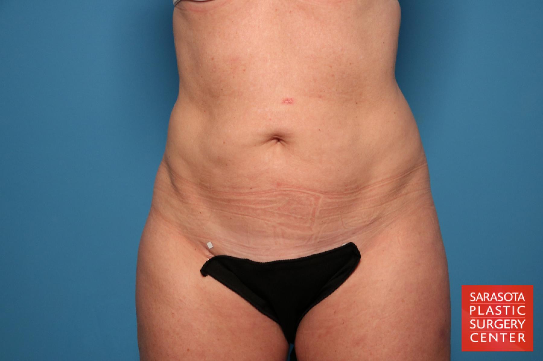 Tummy Tuck: Patient 1 - Before 1