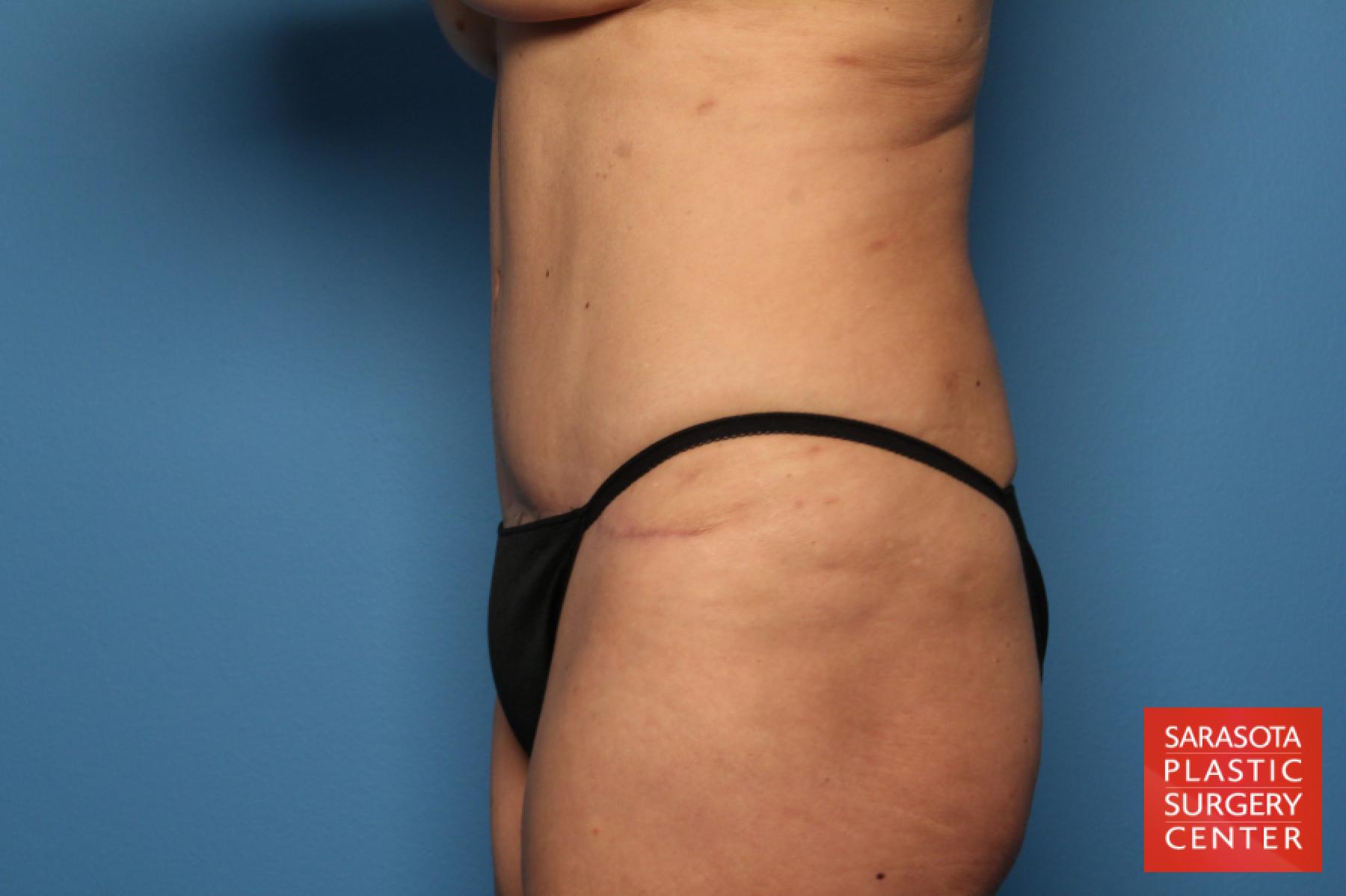 Tummy Tuck: Patient 4 - After 3