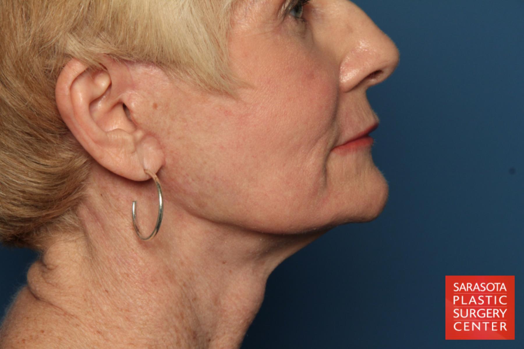 Laser Skin Resurfacing - Face: Patient 15 - After 5
