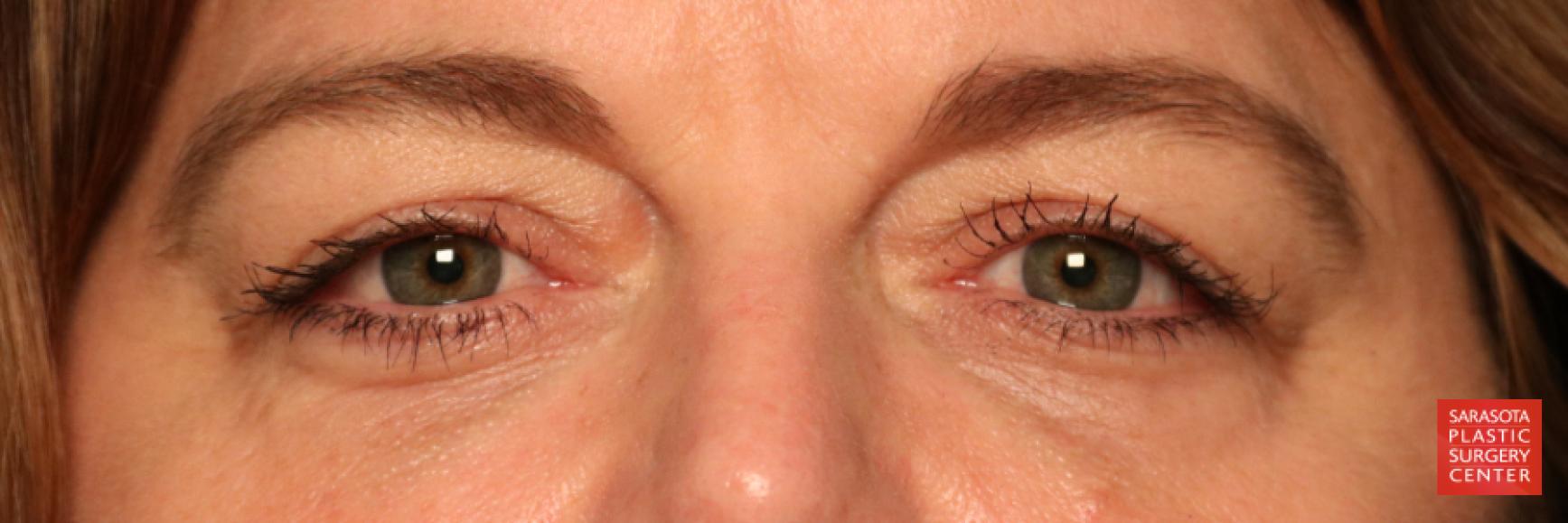 Eyelid Lift: Patient 5 - Before 