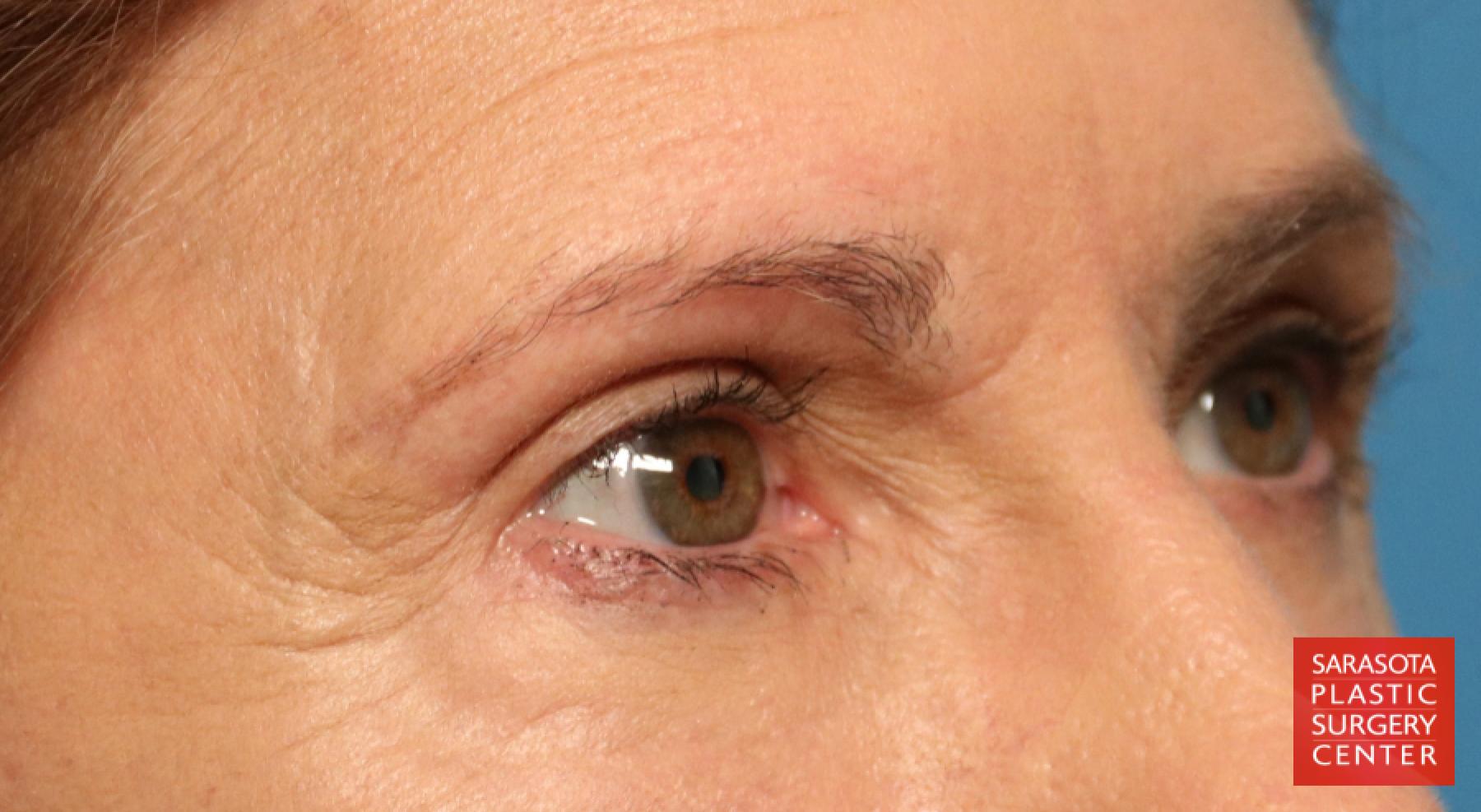 Eyelid Lift: Patient 28 - After 4