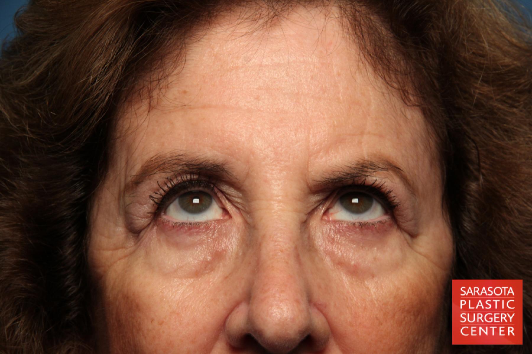 Eyelid Lift: Patient 42 - Before 3