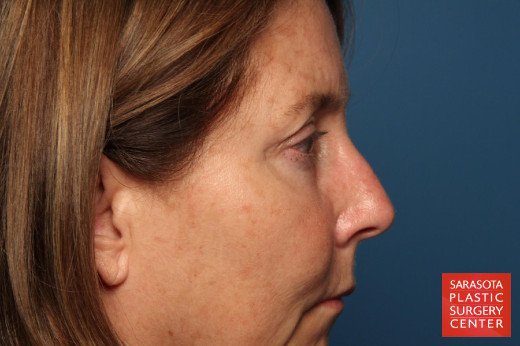 Eyelid Lift: Patient 35 - Before and After 5