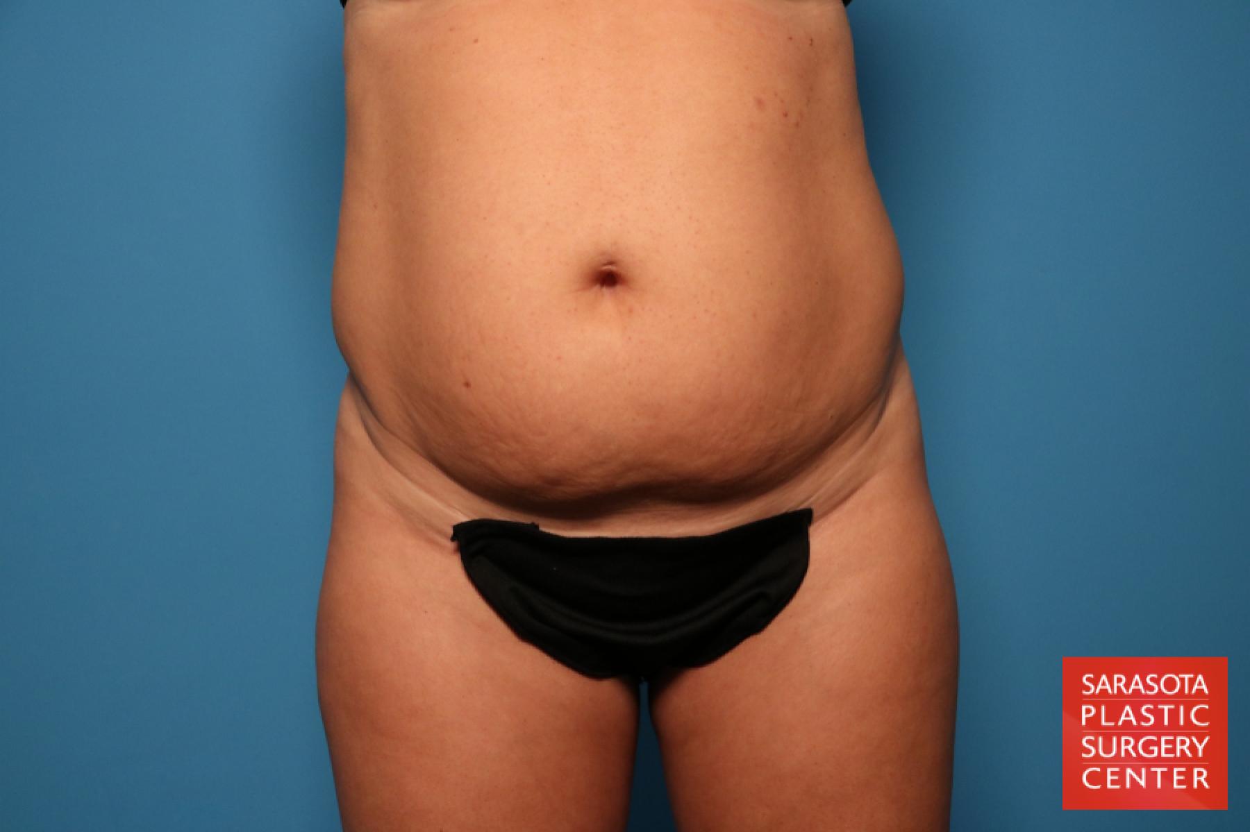 Tummy Tuck: Patient 24 - Before 1