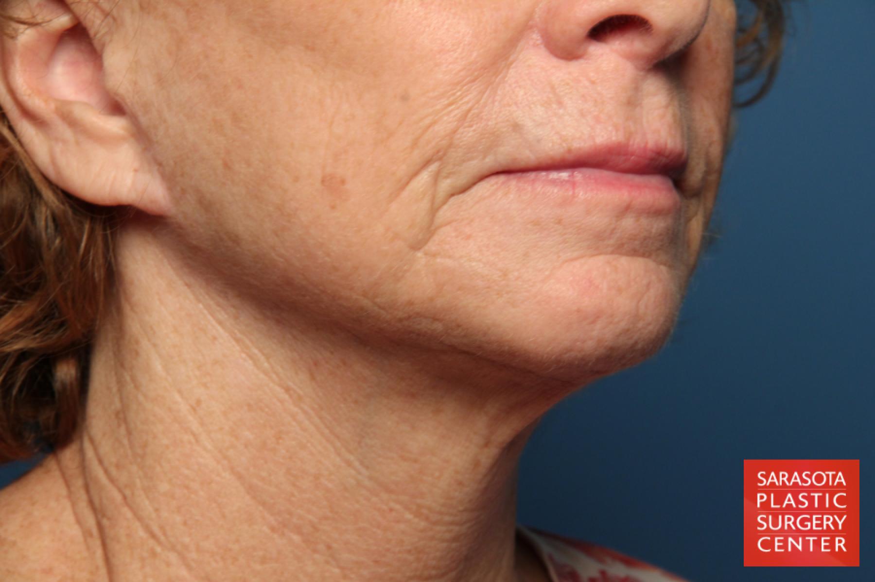 Laser Skin Resurfacing - Face: Patient 12 - Before and After 3