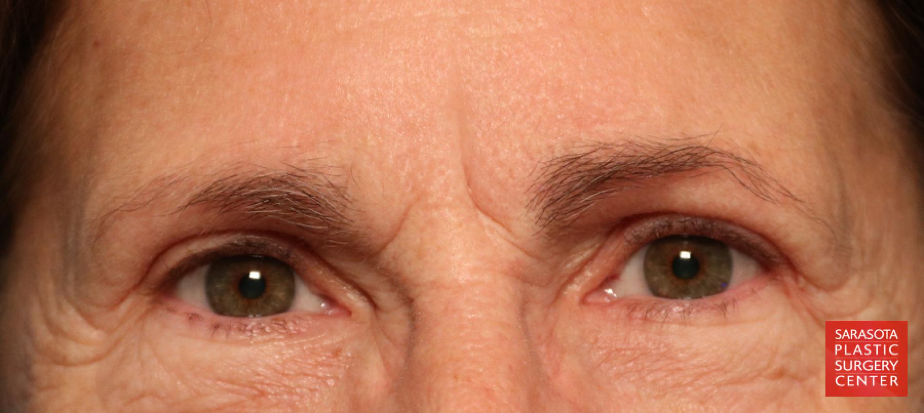 Brow Lift: Patient 1 - Before 1