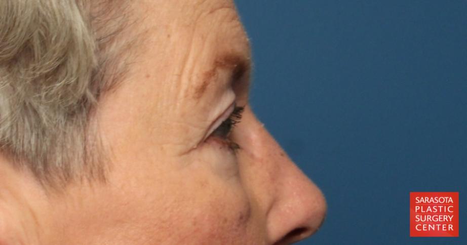 Eyelid Lift: Patient 34 - Before and After 3
