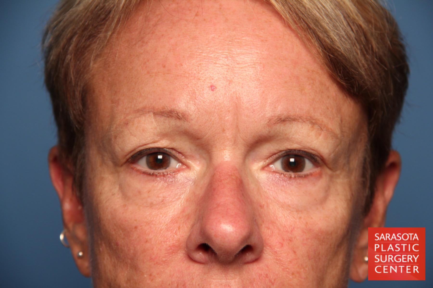 Eyelid Lift: Patient 18 - Before 1