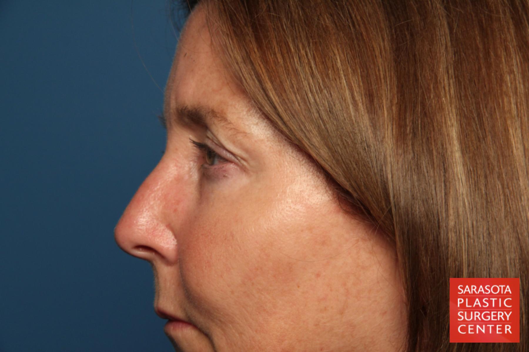 Eyelid Lift: Patient 35 - Before 3