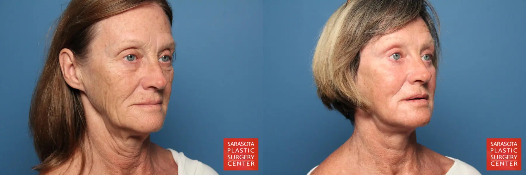 Laser Skin Resurfacing - Face: Patient 11 - Before and After 2