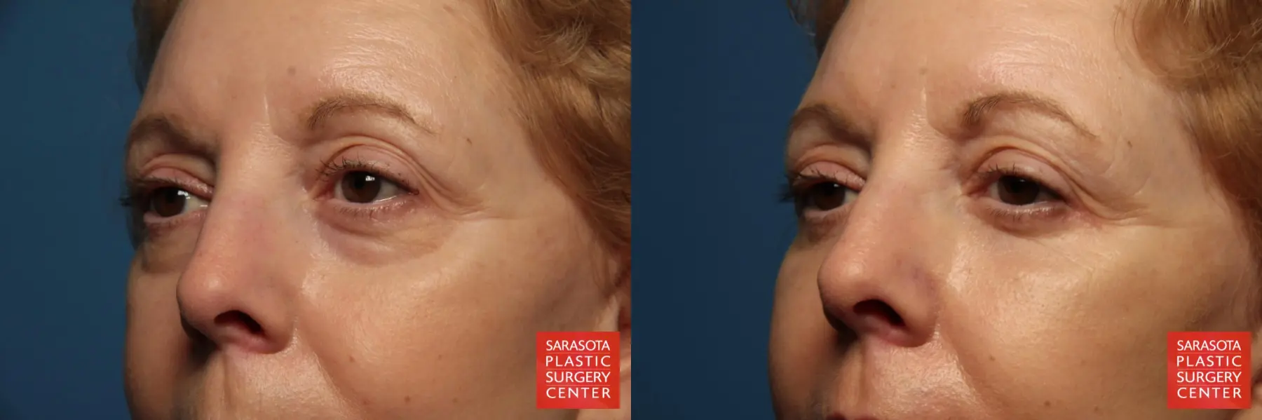 Laser Skin Resurfacing - Face: Patient 5 - Before and After 4