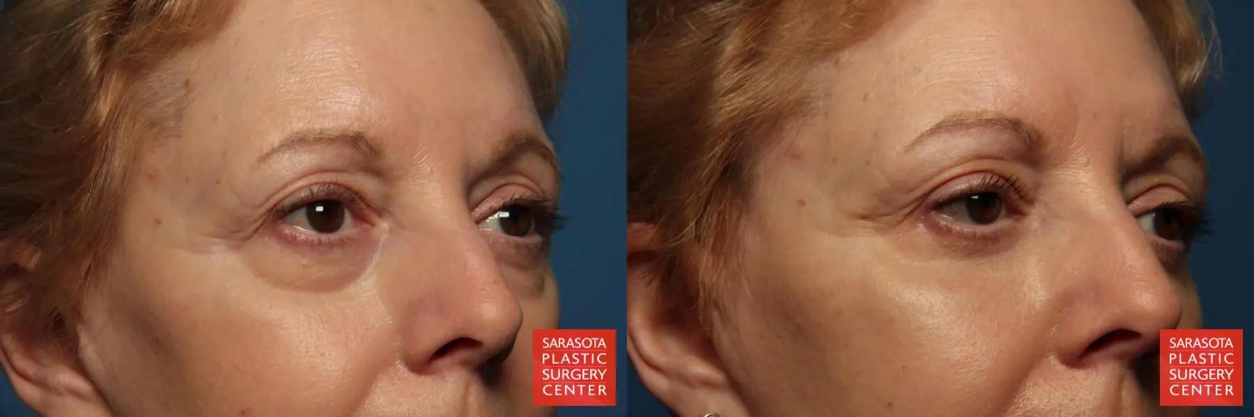 Laser Skin Resurfacing - Face: Patient 5 - Before and After 5