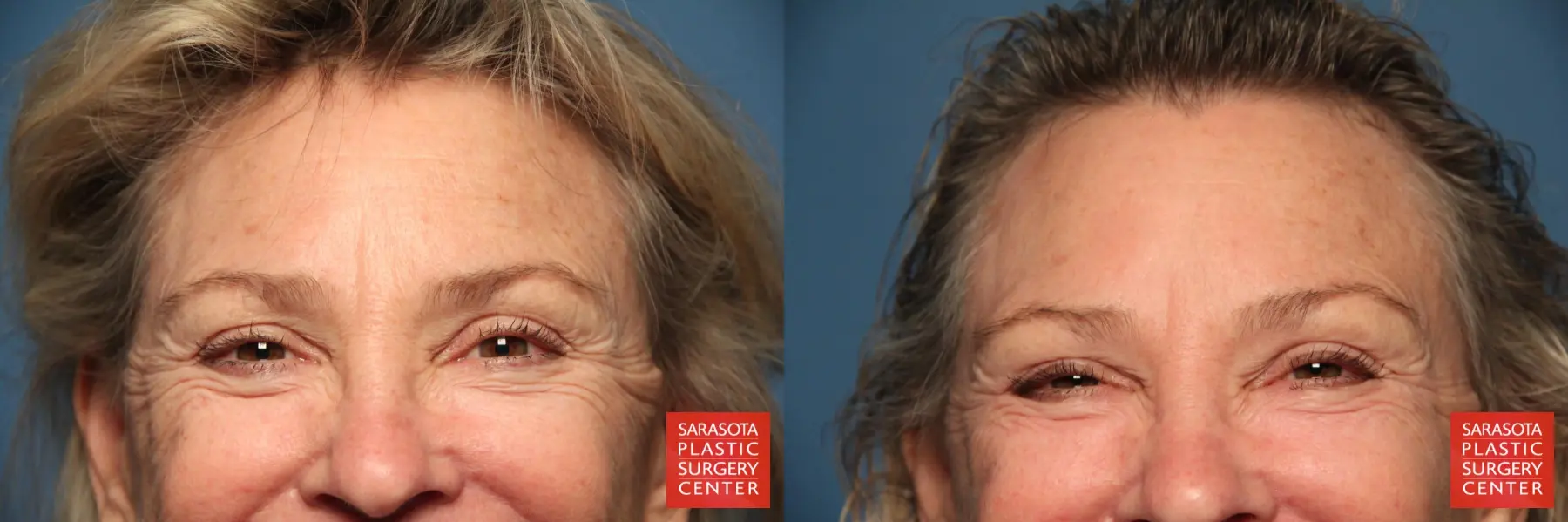 Laser Skin Resurfacing - Face: Patient 9 - Before and After 5
