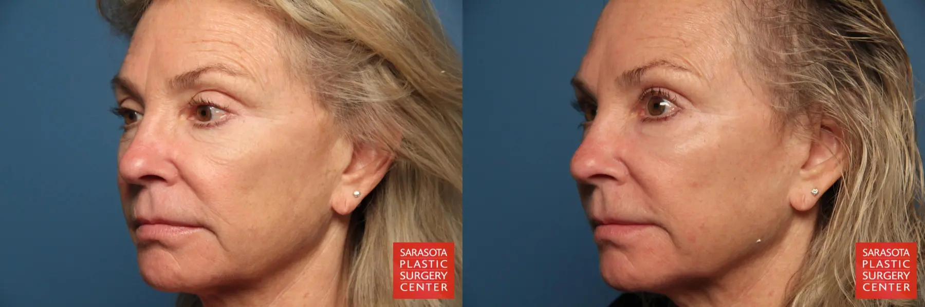 Laser Skin Resurfacing - Face: Patient 9 - Before and After 2