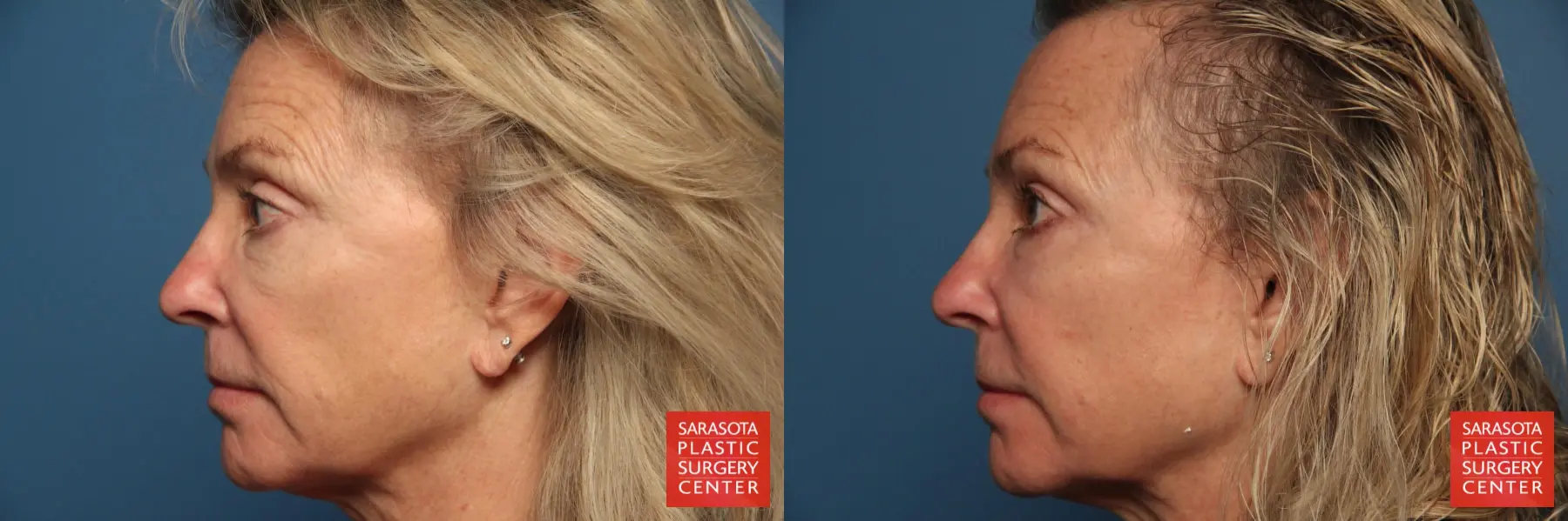 Laser Skin Resurfacing - Face: Patient 9 - Before and After 3