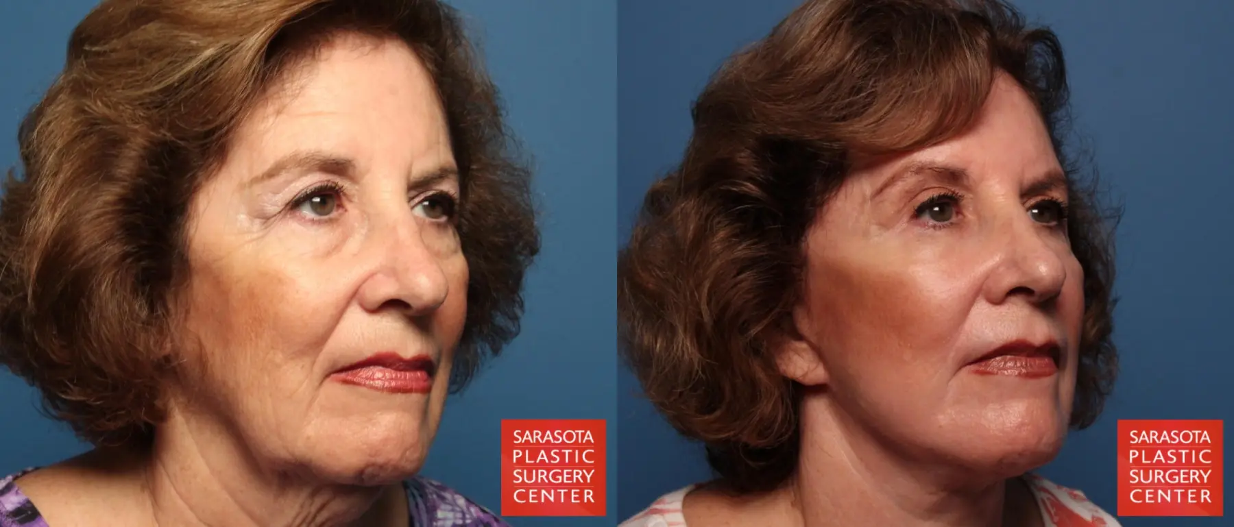 Laser Skin Resurfacing - Face: Patient 6 - Before and After 2