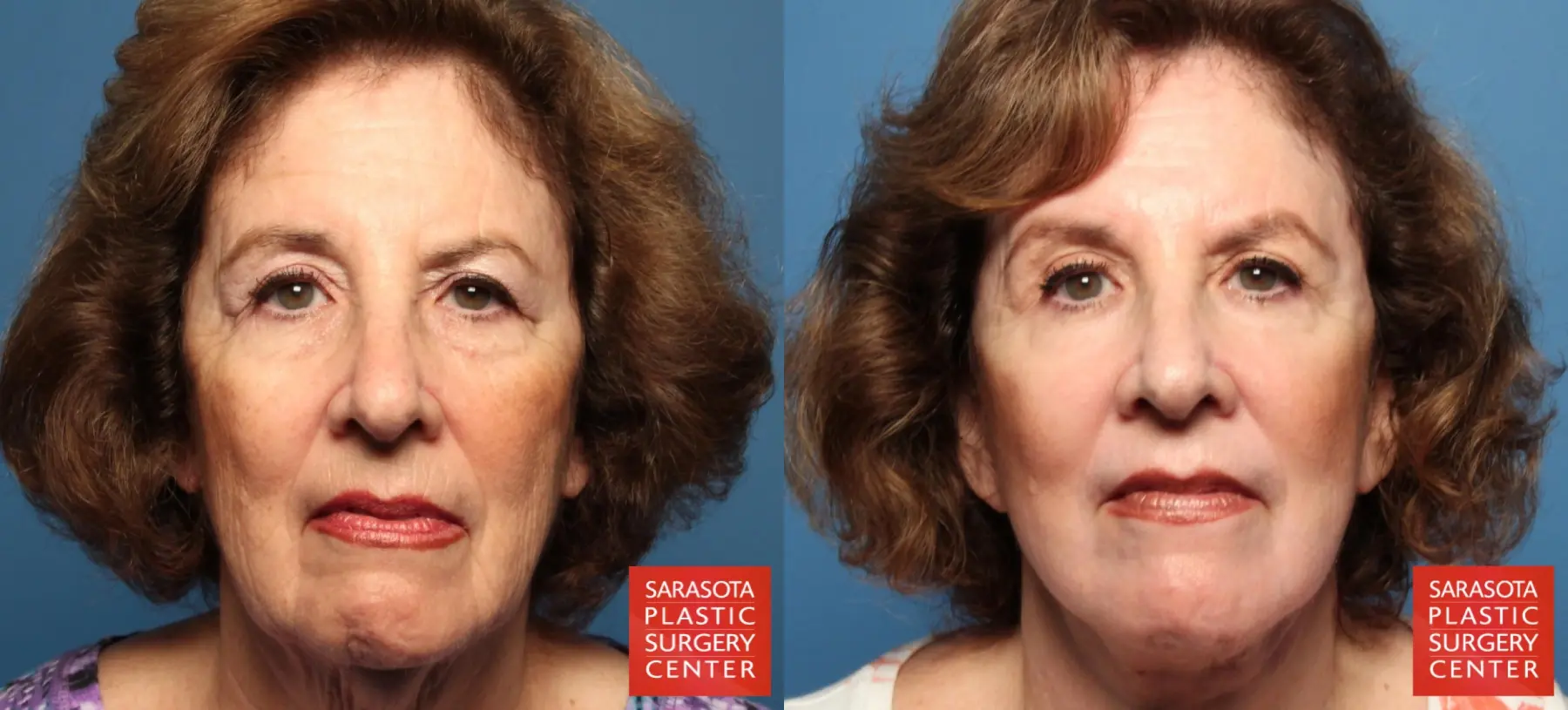 Laser Skin Resurfacing - Face: Patient 6 - Before and After  