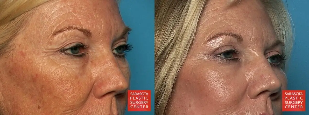 Laser Skin Resurfacing - Face: Patient 2 - Before and After 3