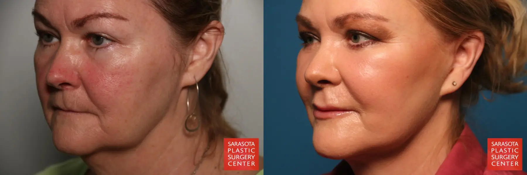 Laser Skin Resurfacing - Face: Patient 17 - Before and After 2
