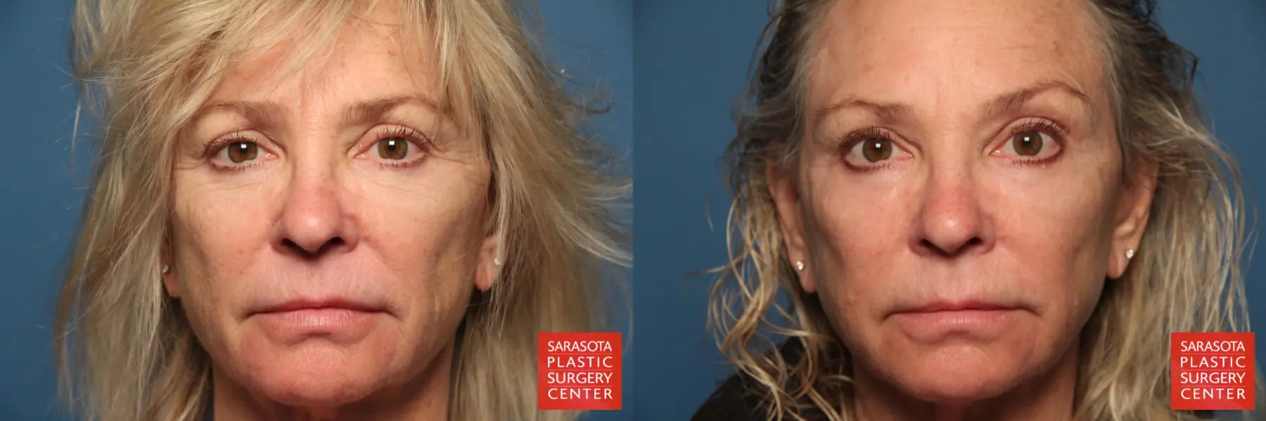 Laser Skin Resurfacing - Face: Patient 9 - Before and After  
