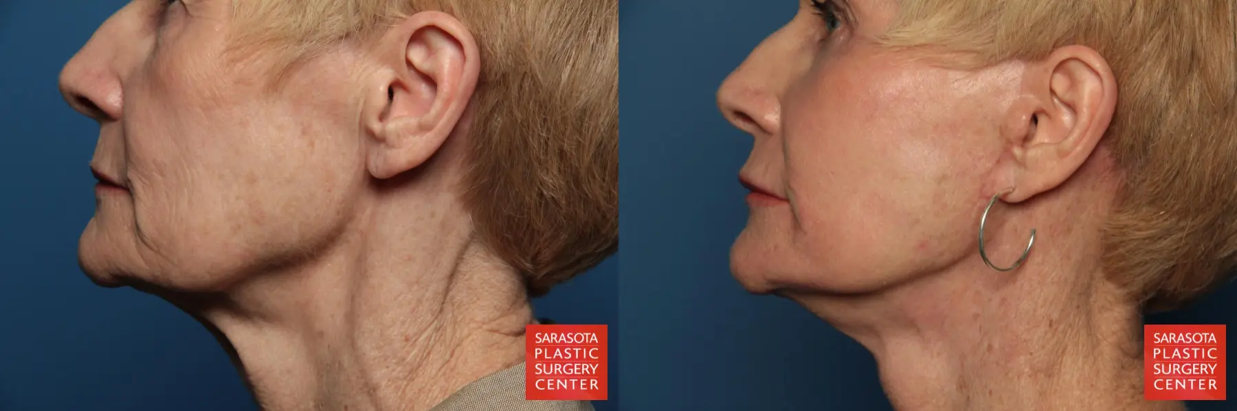 Laser Skin Resurfacing - Face: Patient 15 - Before and After 3