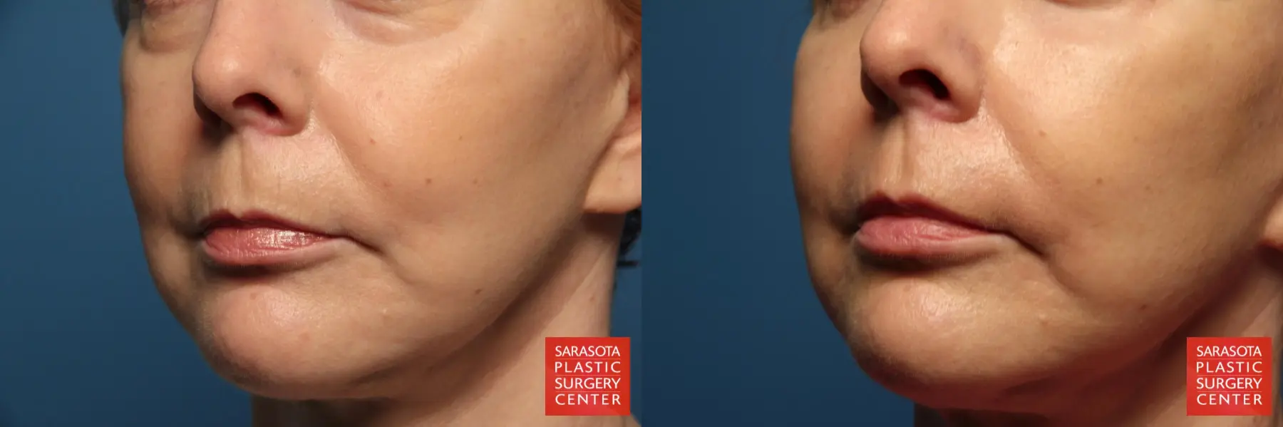 Laser Skin Resurfacing - Face: Patient 5 - Before and After 2