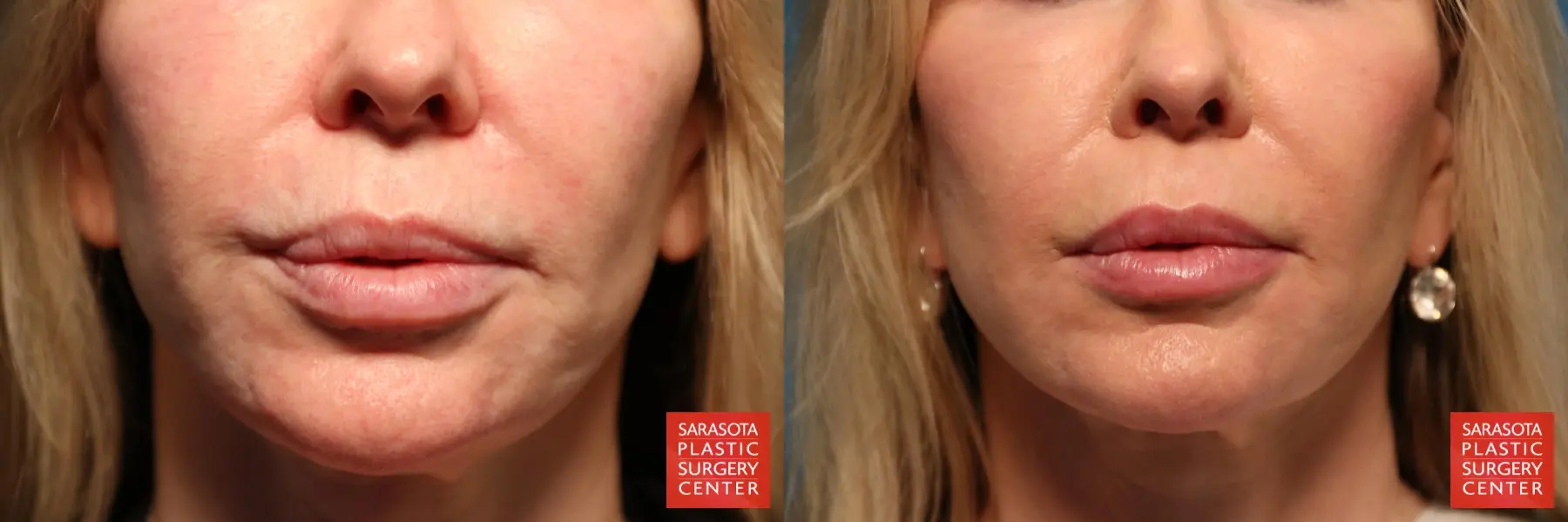 Laser Skin Resurfacing - Face: Patient 7 - Before and After  