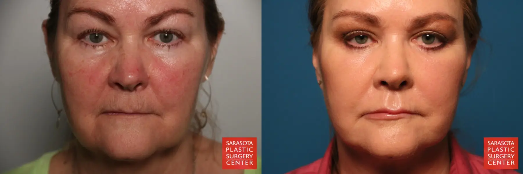 Laser Skin Resurfacing - Face: Patient 17 - Before and After 1