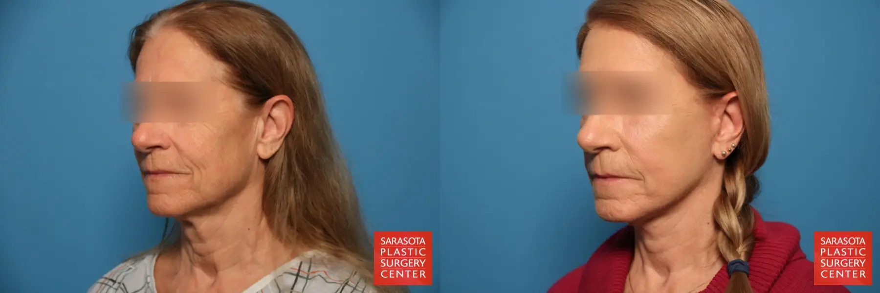 Laser Skin Resurfacing - Face: Patient 13 - Before and After 2