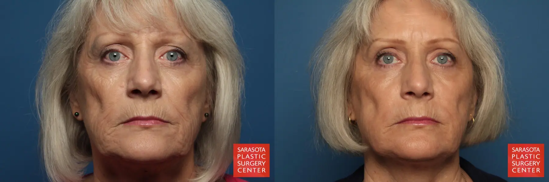 Laser Skin Resurfacing - Face: Patient 3 - Before and After  