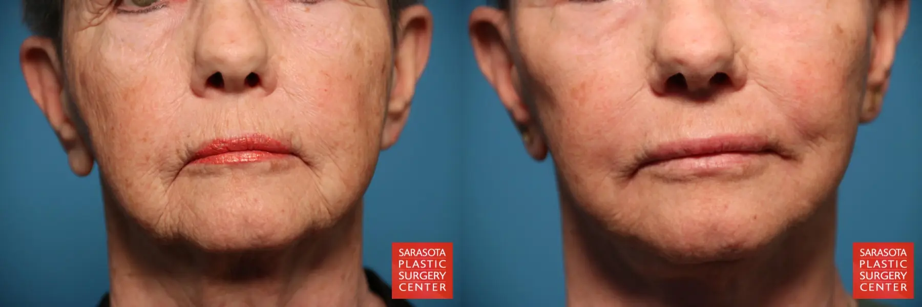 Laser Skin Resurfacing - Face: Patient 25 - Before and After  