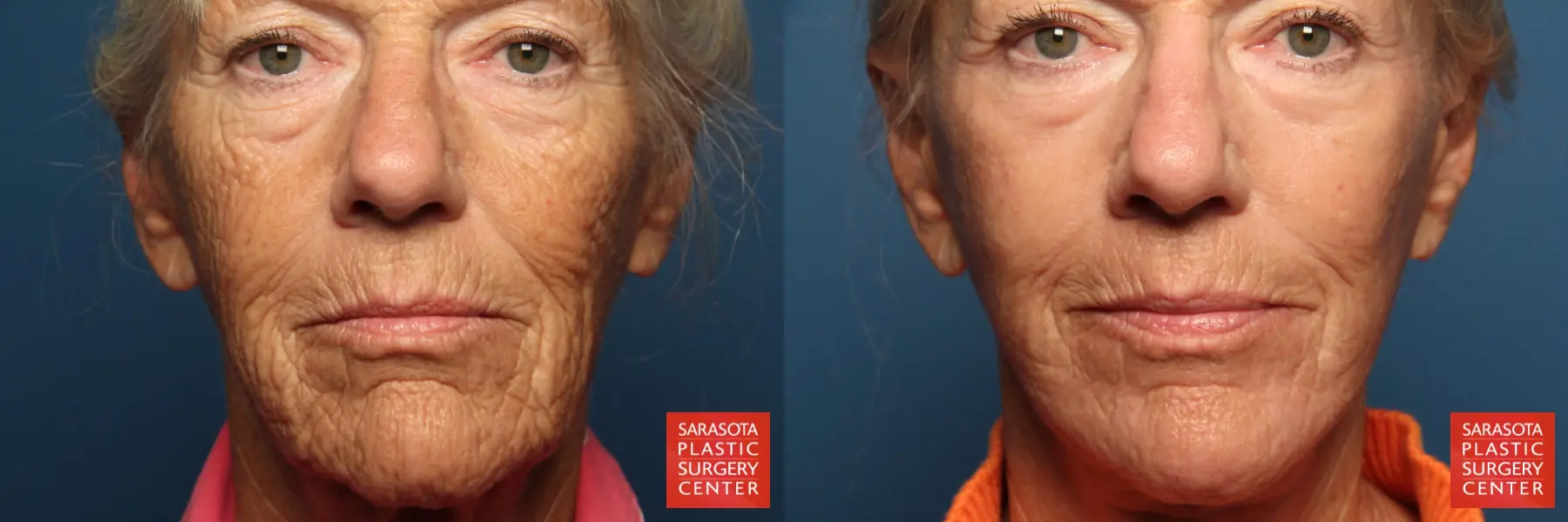 Laser Skin Resurfacing - Face: Patient 8 - Before and After 1