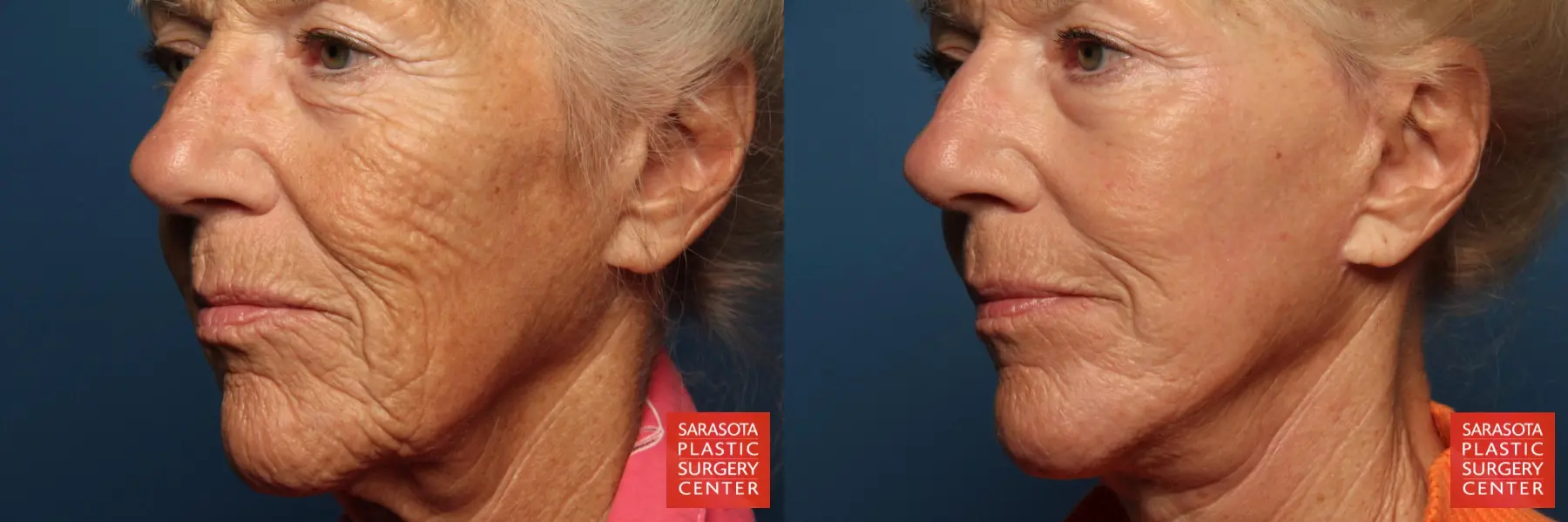Laser Skin Resurfacing - Face: Patient 8 - Before and After 2