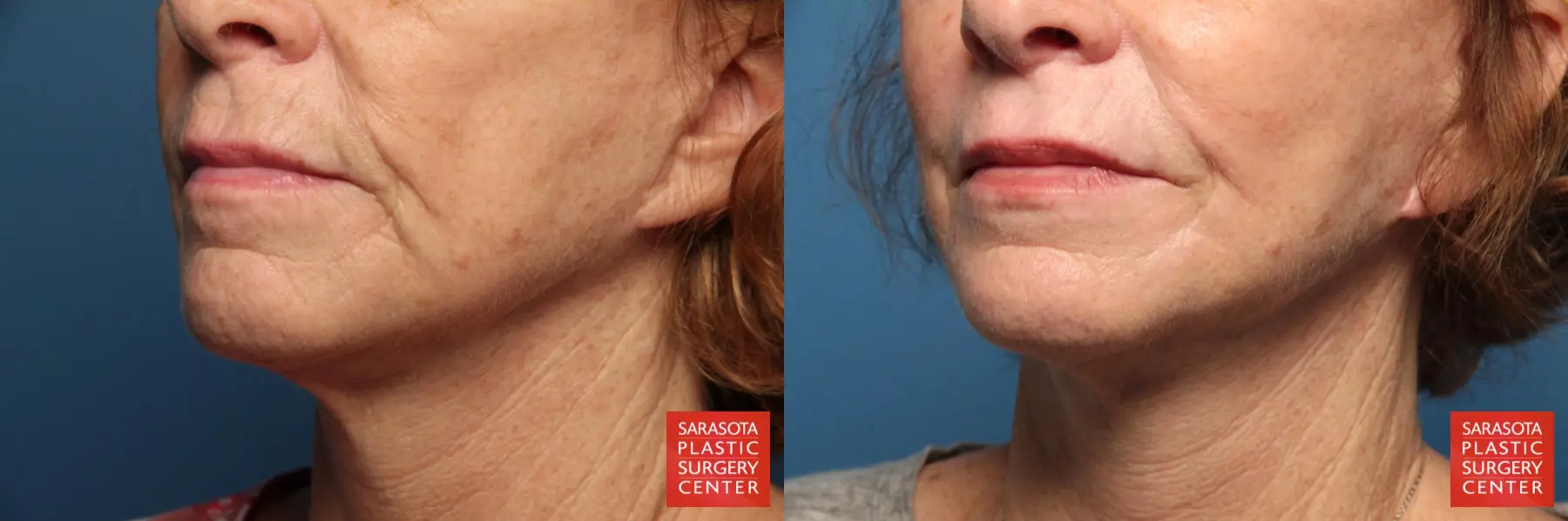 Laser Skin Resurfacing - Face: Patient 12 - Before and After 2
