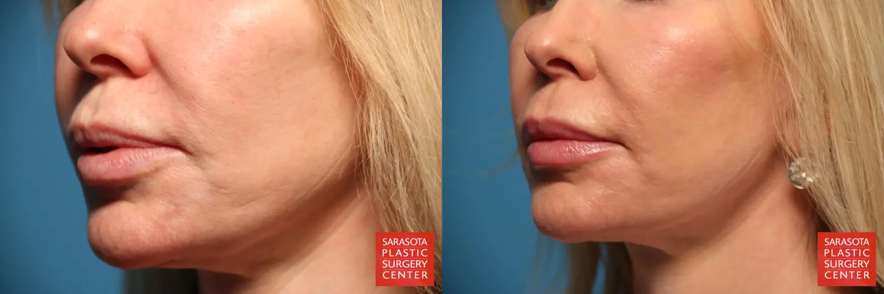 Laser Skin Resurfacing - Face: Patient 7 - Before and After 2
