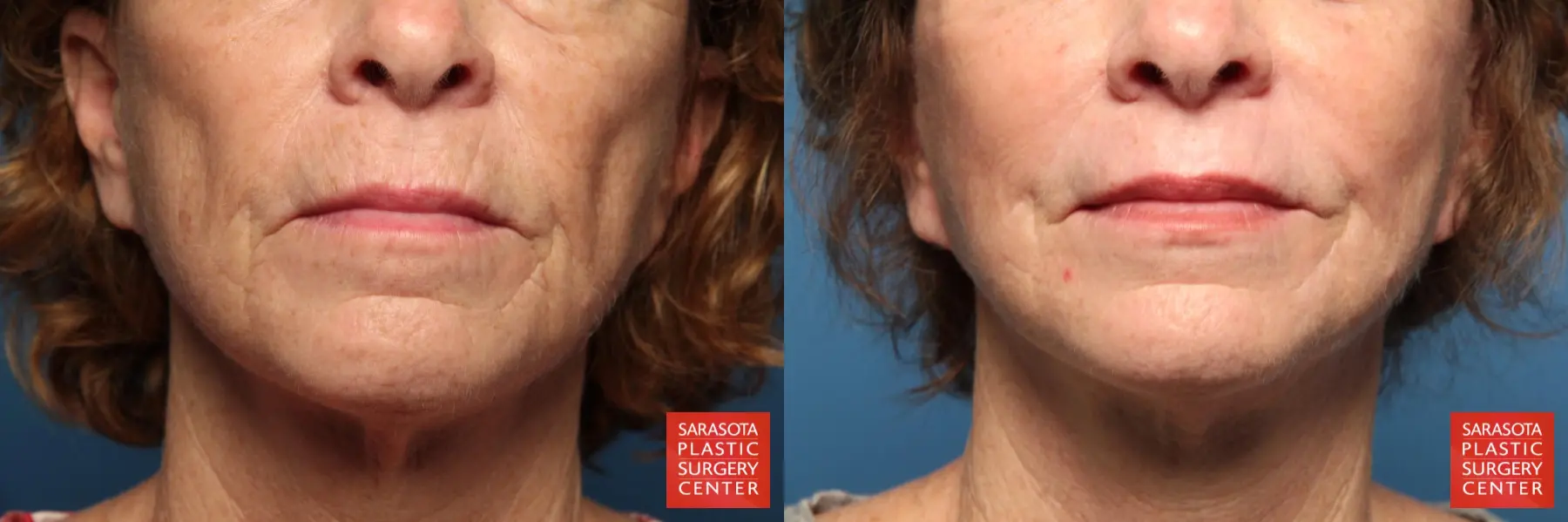 Laser Skin Resurfacing - Face: Patient 12 - Before and After  