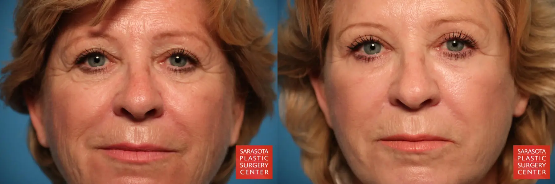 Laser Skin Resurfacing - Face: Patient 10 - Before and After  