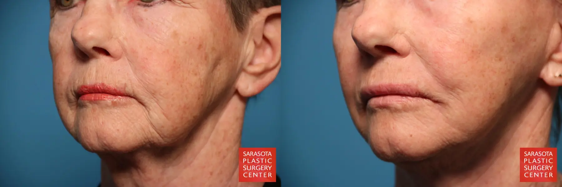 Laser Skin Resurfacing - Face: Patient 14 - Before and After 2