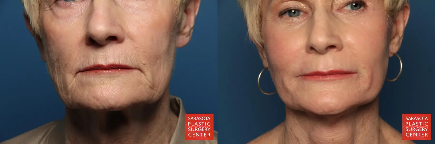 Laser Skin Resurfacing - Face: Patient 15 - Before and After 1