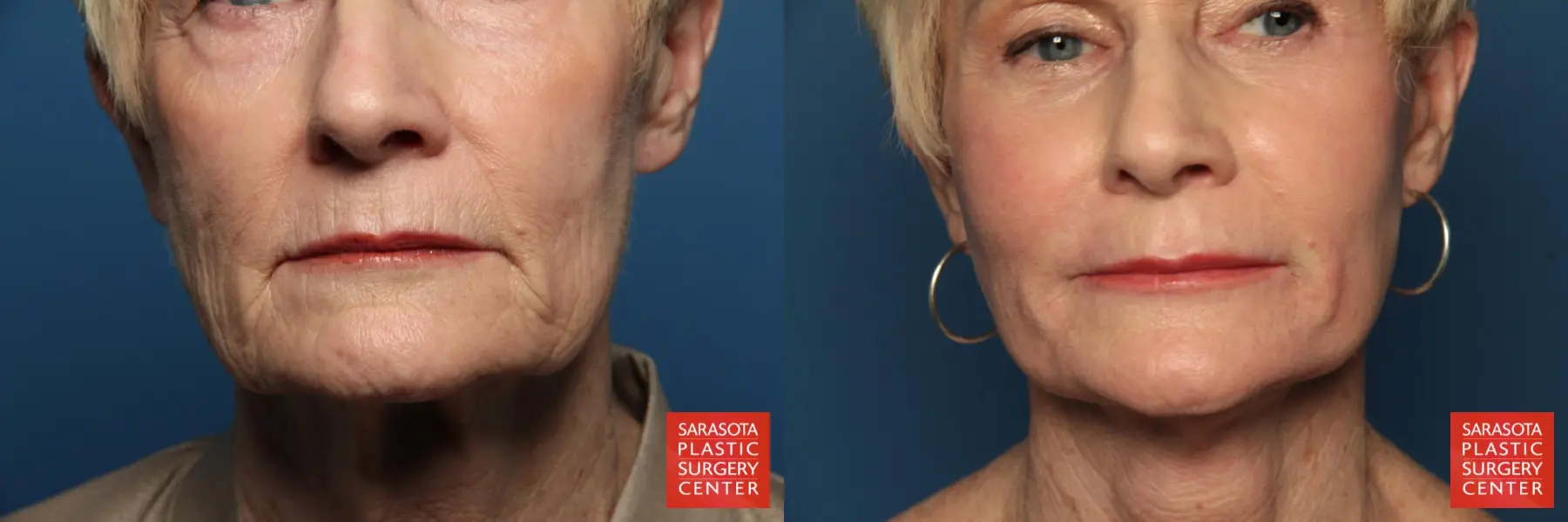 Laser Skin Resurfacing - Face: Patient 15 - Before and After  