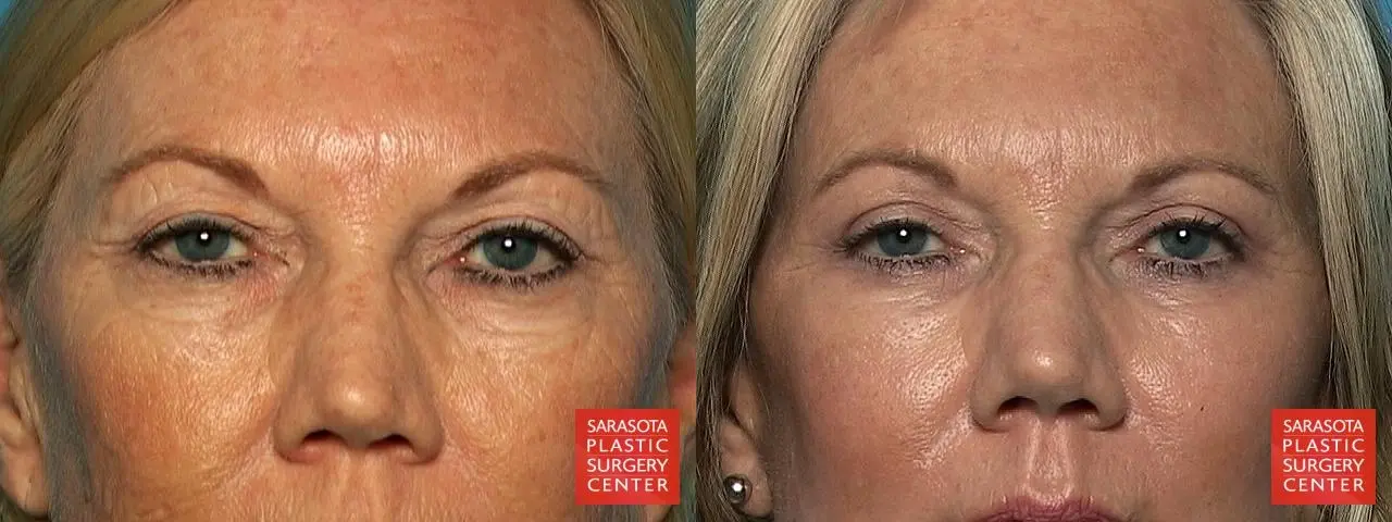 Laser Skin Resurfacing - Face: Patient 2 - Before and After  