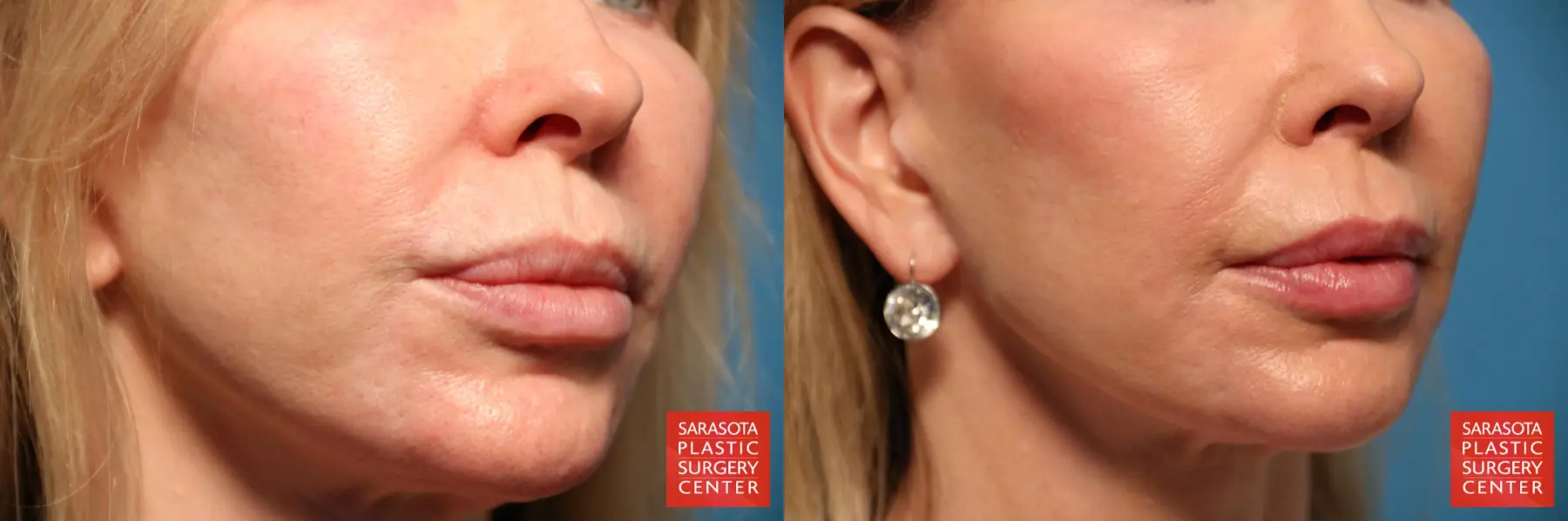 Laser Skin Resurfacing - Face: Patient 7 - Before and After 3