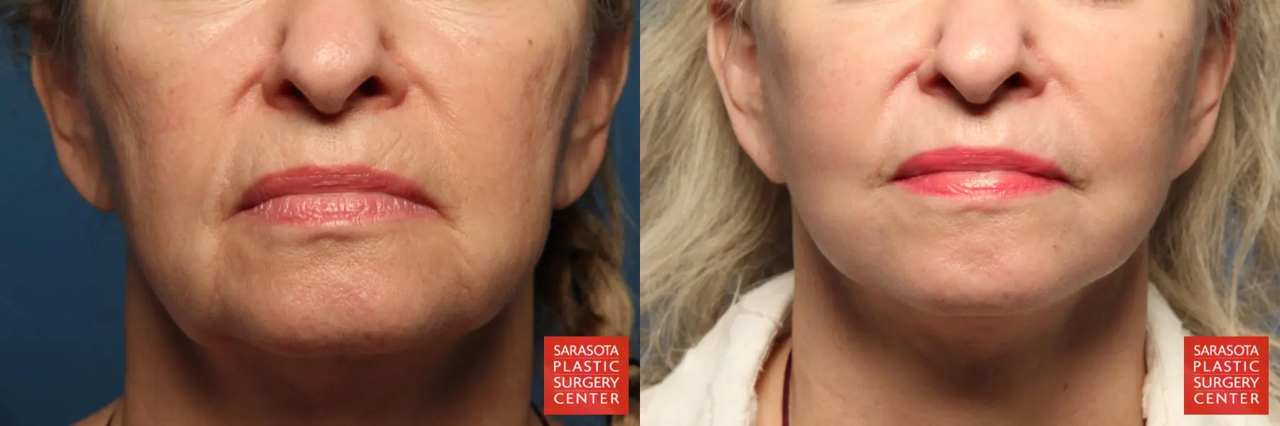 Laser Skin Resurfacing - Face: Patient 1 - Before and After  