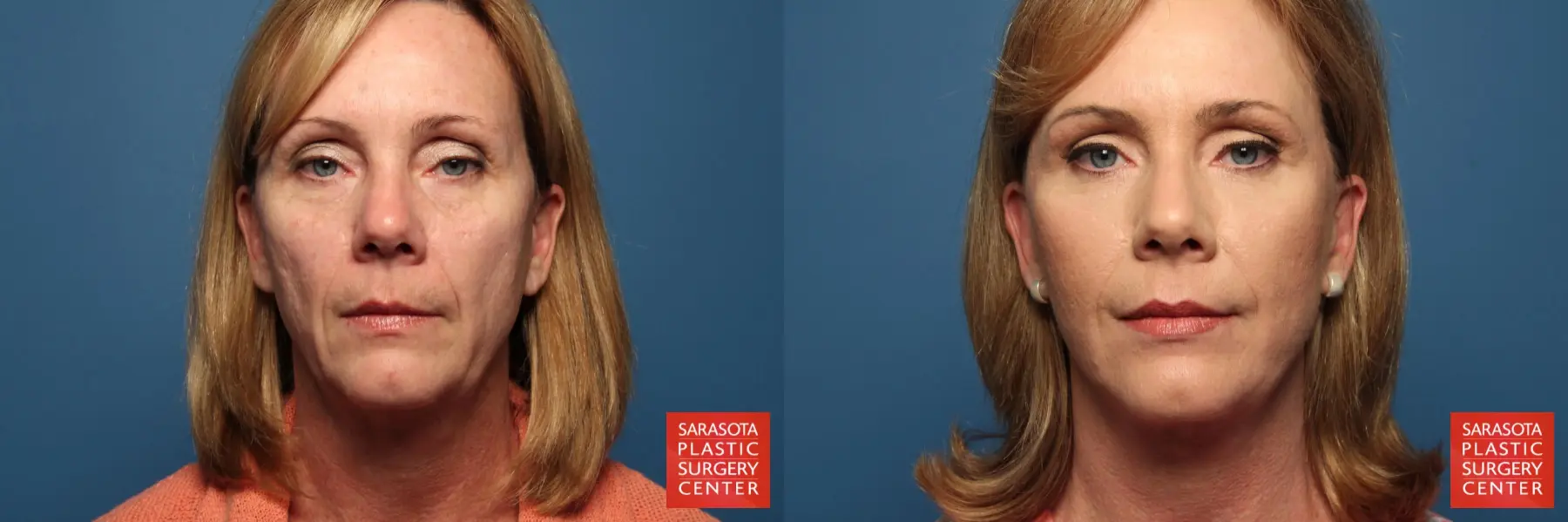 Laser Skin Resurfacing - Face: Patient 4 - Before and After 1