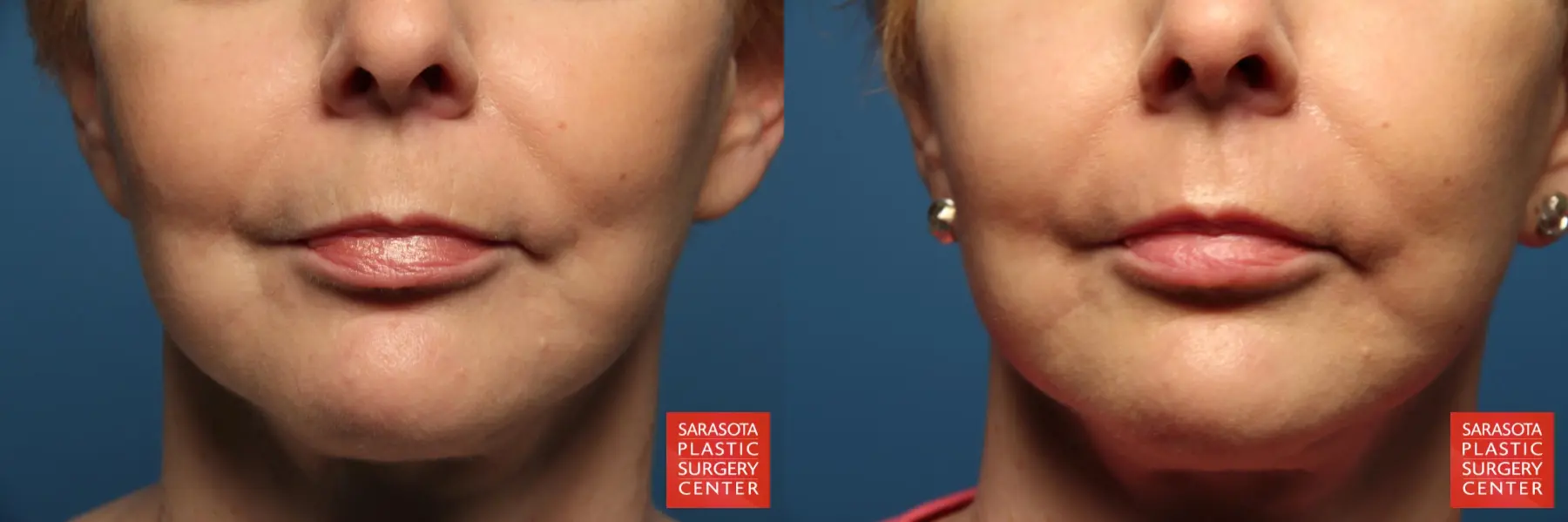 Laser Skin Resurfacing - Face: Patient 8 - Before and After  