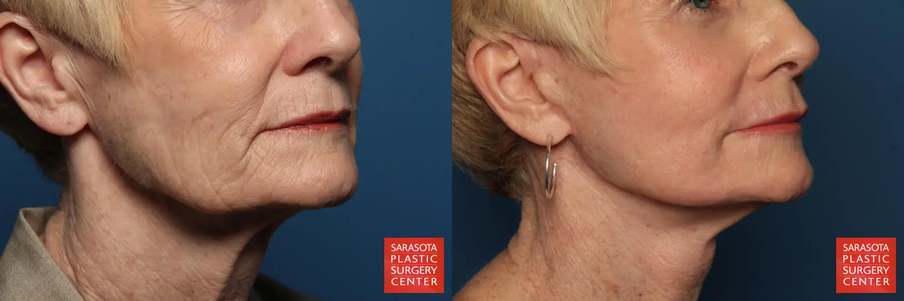 Laser Skin Resurfacing - Face: Patient 15 - Before and After 4